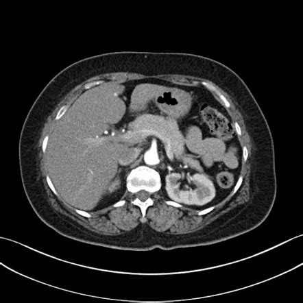 CT pancreas (protocol) | Radiology Reference Article | Radiopaedia.org