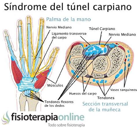 Sindrome Tunel Carpo Trabalho