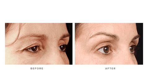 Thermage Eye Before and After Images | Infinity Skin Clinic