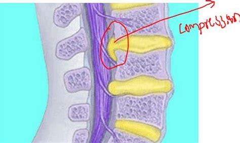 Thecal Sac - Structure, Compression (Impingement) Causes