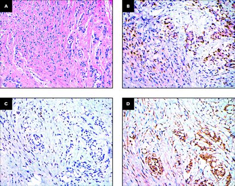 Biphasic mesothelioma. A, B, Both epithelial and spindle cell ...