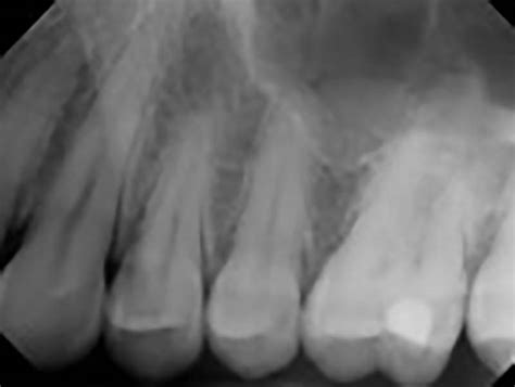 Dental x-rays | University of Michigan School of Dentistry