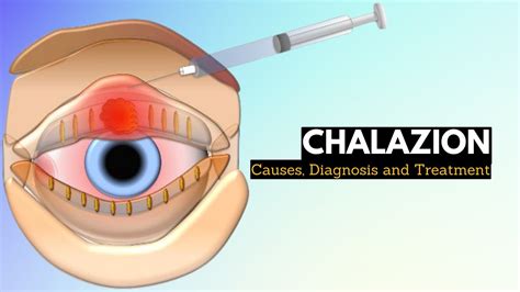 CHALAZION, Causes, Signs and Symptoms, Diagnosis and Treatment. - YouTube