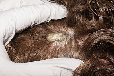 Scalp plaque | Clinician Reviews