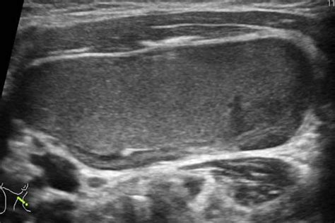 Branchial Cleft Cyst Ultrasound