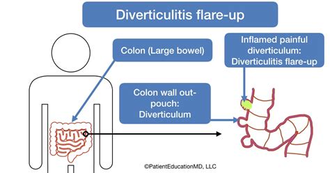 Symptoms of diverticulitis flare-up - PatientEducationMD