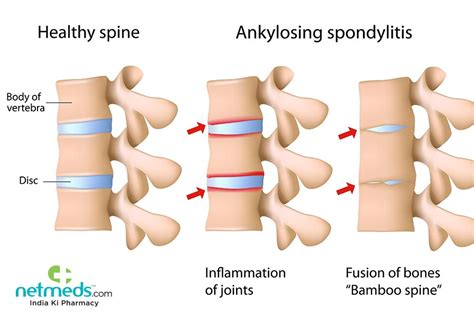 Ankylosing Spondylitis: Causes, Symptoms and Treatment