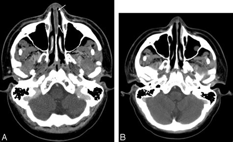 Nasal Septal Abscess in Patients with Immunosuppression | American Journal of Neuroradiology