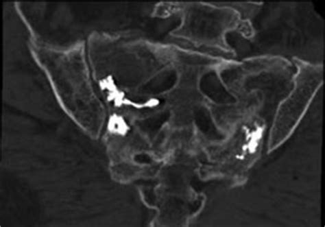 Sacroplasty - Imaging Glossary - Patients - UR Medicine Imaging Sciences (Radiology ...