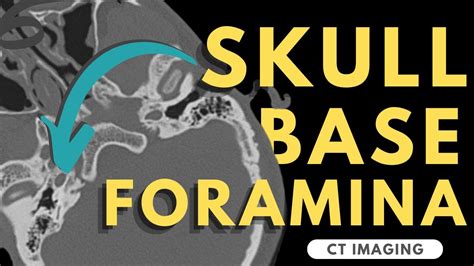 Skull Base Foramina | Radiology anatomy part 1 prep | CT imaging of skull base - YouTube