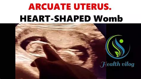 ARCUATE UTERUS. HEART-SHAPED Womb #pregnancy #pregnancytips #baby # ...