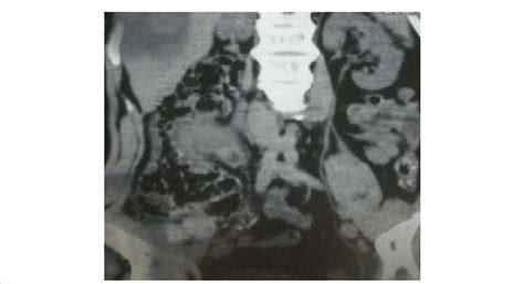 CT demonstrating appendicular mass. | Download Scientific Diagram