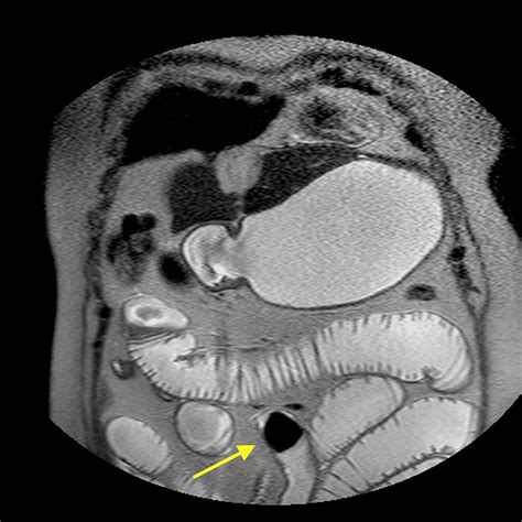 Synchronous Gallstone Ileus and Bouveret’s Syndrome: A Report of Two Rare Concurrent ...