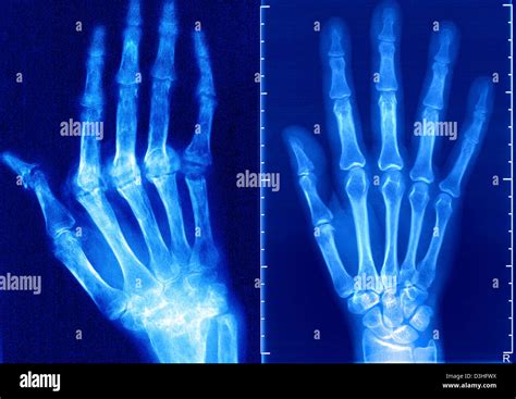 Rheumatoid arthritis hands x ray hi-res stock photography and images ...