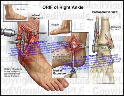 ORIF of Right Ankle - Medivisuals Inc.