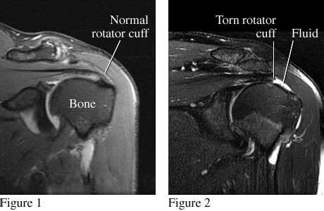 Mri Image Of Torn Rotator Cuff - Smyth Fave1963