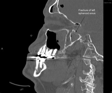 Dramatic Visual Recovery in Untreated Indirect Traumatic Optic Neuropathy