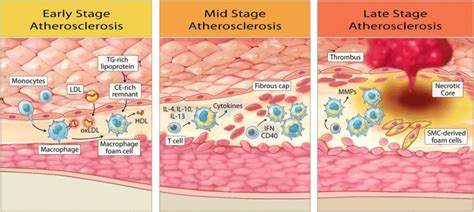 Icosapent ethyl (IPE) modulates the entire atherosclerosis continuum... | Download Scientific ...