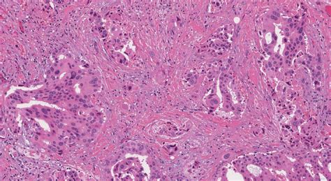 Salivary duct carcinoma | Ottawa Atlas of Pathology