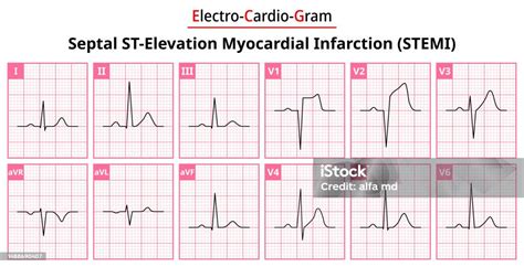 Septal Stemi The Differences In Ecg Waveform For Each Of The 12 Leads ...