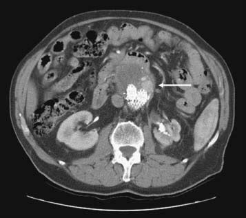 28 Embolization for Type 2 Endoleak after Aortic Stent Graft ...