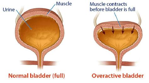 Treatment Options for Overactive Bladder – Entirely Health