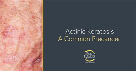 Actinic Keratosis Skin Cancer