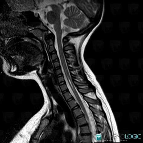 Radiology case : Hydromyelia (MRI) - Diagnologic