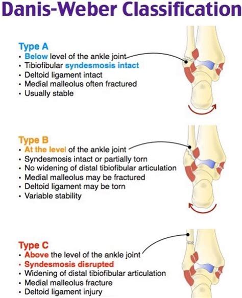 Weber classification of ankle fractures – Artofit