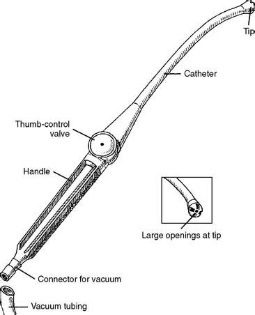 Suctioning the Airway | Clinical Gate