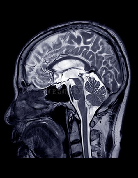 Sagittal Brain Mri Labeled