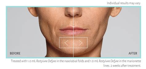 Restylane Refyne and Defyne - Debra Tanner Abell, MD