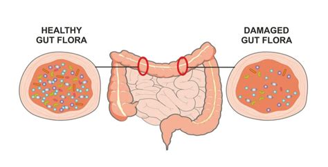 What Leads To Candida In The Stool? | IBS Gut Health Clinic