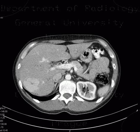 Radiology case: Focal nodular hyperplasia, FNH