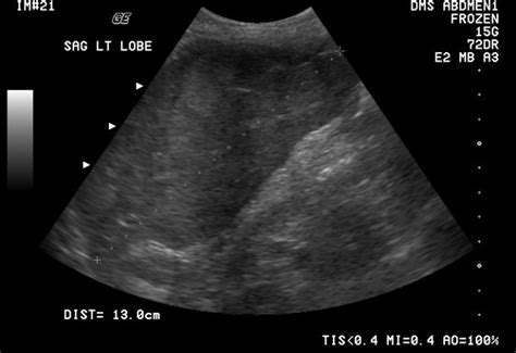 Normal Liver Size on Ultrasound - radRounds Radiology Network