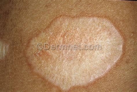 Lichen Sclerosus Skin Photo - Skin Disease Pictures