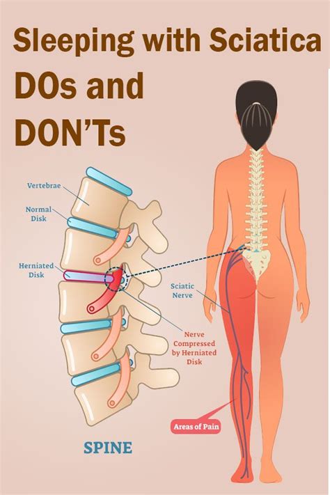 Sleeping with Sciatica - DOs and DON'Ts - The Health Science Journal | Sciatic nerve, Sciatic ...