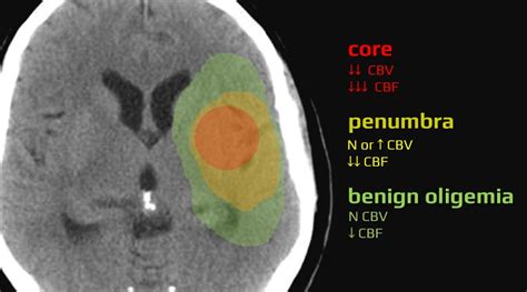 Ischemic penumbra | STROKE MANUAL