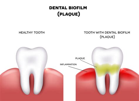 What is Dental Plaque and How Can My Denver Dentist Help?