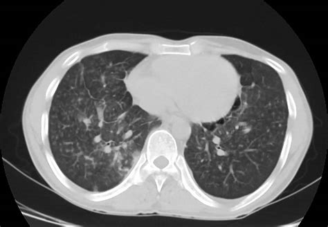 Silicosis causes, symptoms, diagnosis, treatment & silicosis prognosis