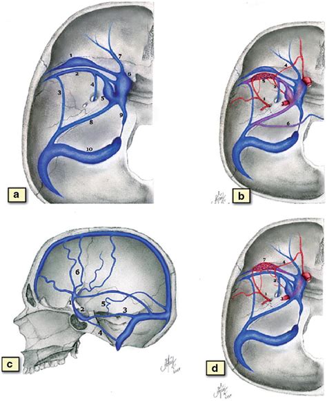 Sphenoidal dural arteriovenous fistula venous and arterial... | Download Scientific Diagram