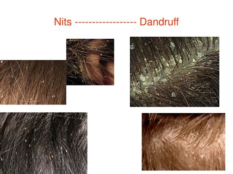 PPT - Dandruff & nits PowerPoint Presentation, free download - ID:8742800