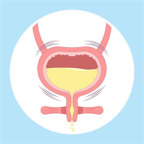 Anuria: Causes, Symptoms & Treatment