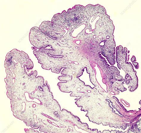 Human cervical polyp, light micrograph - Stock Image - C049/8812 ...