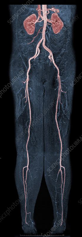 Femoral Artery Stenosis, MRA - Stock Image - C009/4668 - Science Photo Library