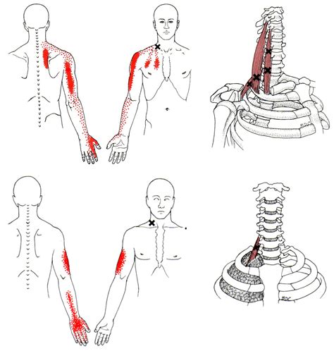 Scalene | The Trigger Point & Referred Pain Guide