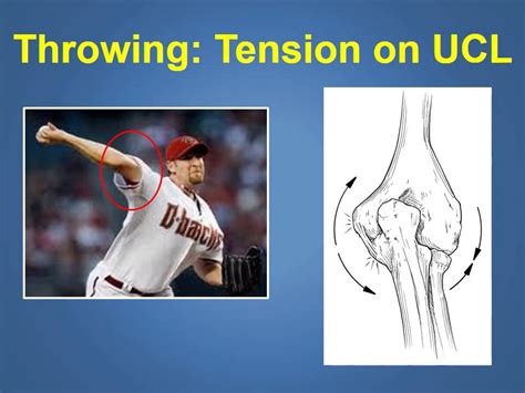 Ulnar Collateral Ligament Injuries & Treatment Explained by a Phoenix ...