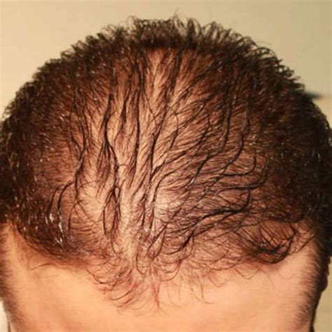 Diffuse Hair Loss Treatment in Mumbai - Cost, Procedure, Causes