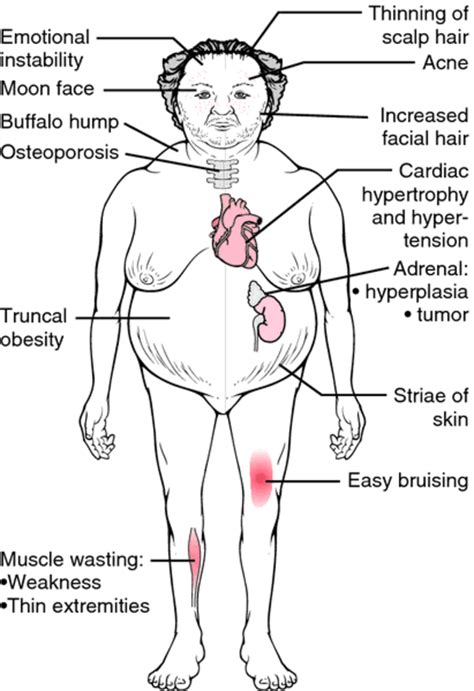 Cushing Syndrome Disease - Causes & Treatment - HubPages