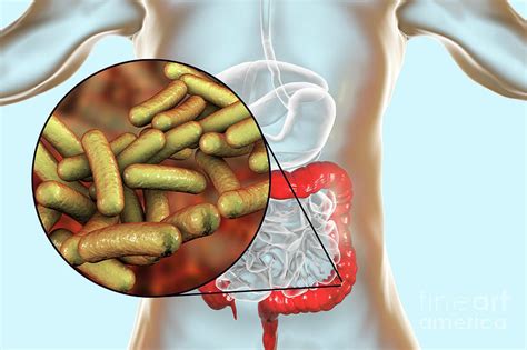 Shigellosis Photograph by Science Photo Library - Pixels